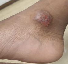 Leg ulcer in a child with sickle cell disease - Is it a complication of the disease or a cutaneous side effect of hydroxyurea treatment?