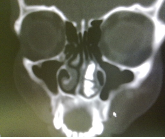 MASS IN NASAL CAVITY