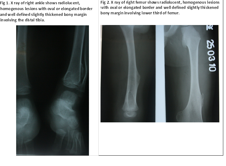 Bony Swellings