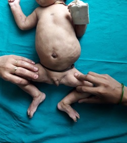 Abdominal Distension