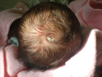 Scalp Defect
