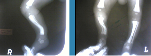 TIBIA DEFORMITY
