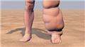 Elephantiasis