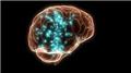 Encephalitis