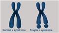 Fragile X Syndrome