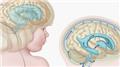 Hydrocephalus