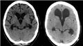 Hydrocephalus Imaging