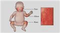Impetigo