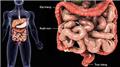 Inflammatory Bowel Disease (IBD)