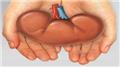 Kidney Transplantation