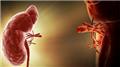 Kidney Transplantation