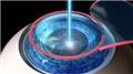 Laser Vision Correction Surgery