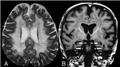 Leukodystrophies - MRI
