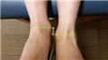 Limb Length Inequality