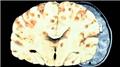 Neurocysticercosis
