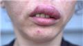 Anaphylaxis