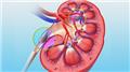 Obstructive Uropathy