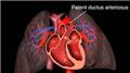 Patent Duct Arteriosus