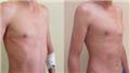 Pectus Carinatum