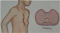 Pectus Excavatum
