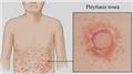 Pityriasis Rosea