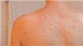 Pityriasis Rosea