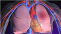 Pulmonary Hypertension