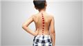 Scoliosis