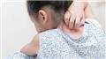 Skin Allergies