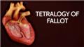 Tetralogy of Fallot