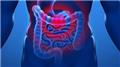 Appendicitis