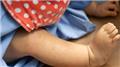 Thrombocytopenia in Newborns