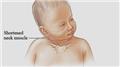 Torticollis