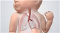Tracheo-Oesophageal Fistula