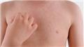 Urticaria (Hives) and Angioedema
