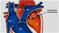 Ventricular Septal Defect