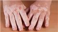 Vitiligo