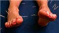 Acupressure and Acupuncture