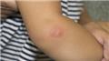 Bites and Stings