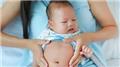 Budd Chiari Syndrome