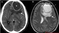 Brain Abscess