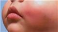 Cellulitis