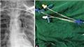 Central Venous Catheterization