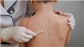 Chickenpox