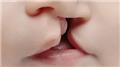 Cleft Lip And Cleft Palate