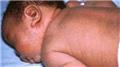 Acanthosis Nigricans