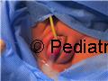 Hydrocolpos in a female newborn