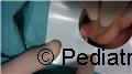 Unusual presentation of foreskin injury: accidental entrapment in bathing shorts mesh lining