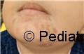 A recalcitrant chin dermatosis