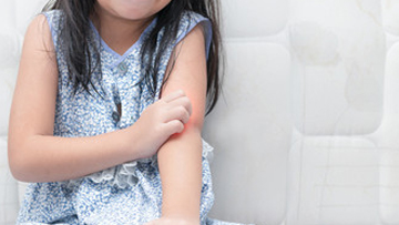 Eczema